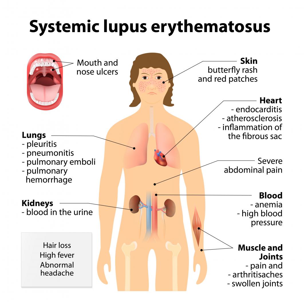 lupus-symptoms.jpg